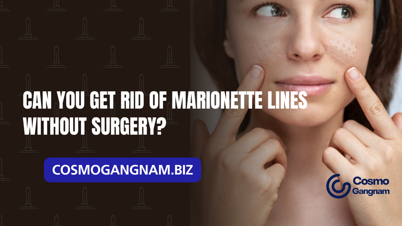 Can You Get Rid of Marionette Lines Without Surgery?