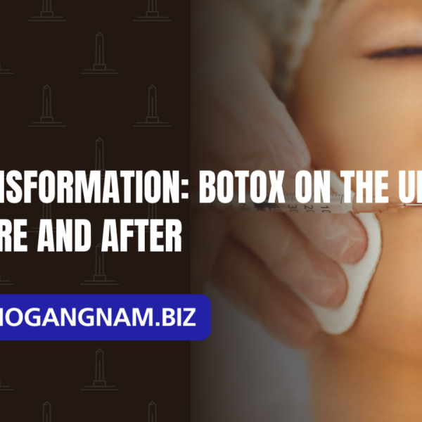 Botox on the Upper Lip Before and After