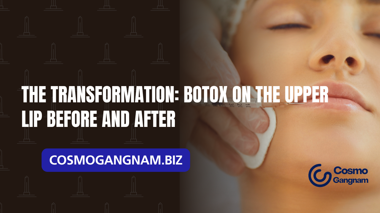 The Transformation: Botox on the Upper Lip Before and After